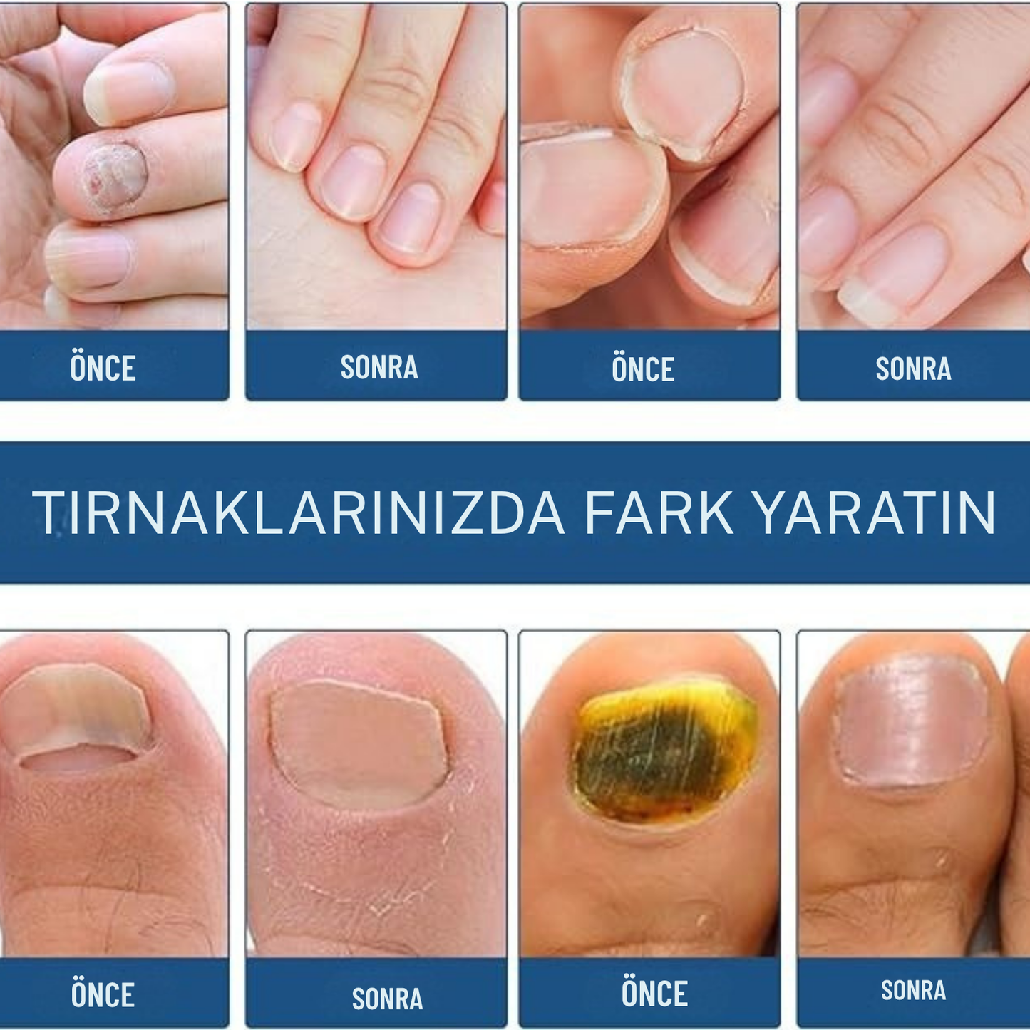 Mantex tırnak bandı